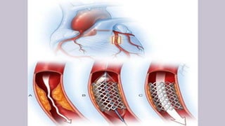 Neuro interventional procedures