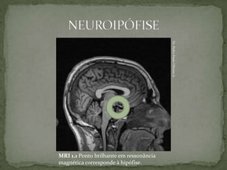 Dr. Pedro Paulo Oliveira Jr.
MRI 1.1 Ponto brilhante em ressonância
magnética corresponde à hipófise.
 