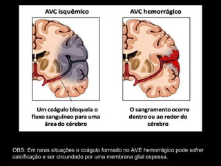OBS: Em raras situações o coágulo formado no AVE hemorrágico pode sofrer calcificação e ser circundado por uma membrana glial espessa. 