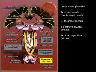 Lesão de via piramidal: 1- proporcionada (fasciobraquiocrural). 2- desproporcionada. 3-Síndrome cruzada pontina. 4- Lesão específica (lacunar). 