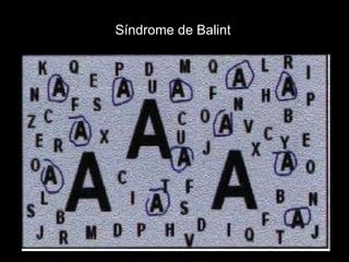 Síndrome de Balint 