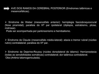 AVE DOS RAMOS DA CEREBRAL POSTERIOR (Síndromes talâmicas e mesencefálicas). Síndrome de Weber (mesencéfalo anterior): hemiplegia fasciobraquiocrural (feixe piramidal); paralisia do IIIº par ipsilateral (diplopia, estrabismo, ptose, midríase).  Pode ser acompanhada por parkinsonismo e hemibalismo. Síndrome de Claude (mesencéfalo médio-lateral): ataxia e tremor rubral (núcleo rubro) contralateral; paralisia do IIIº par. Síndrome de Dejerine-Roussy (núcleo dorsolateral do tálamo): Hemianestesia (todas as sensibilidades somáticas) contralateral; dor talâmica contralateral.  Obs:(Artéria talamogeniculada). 