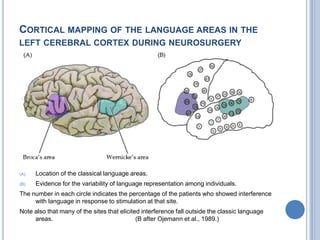 Lateralization of Language: Wada Test
