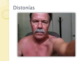 Distonías
 