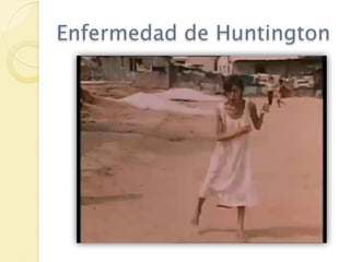 Enfermedad de Huntington
 