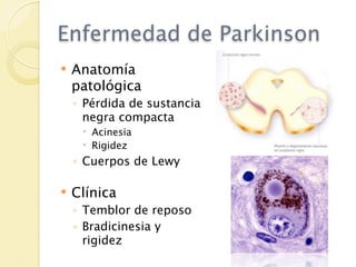 Enfermedad de Parkinson
   Anatomía
    patológica
    ◦ Pérdida de sustancia
      negra compacta
      Acinesia
      Rigidez
    ◦ Cuerpos de Lewy

   Clínica
    ◦ Temblor de reposo
    ◦ Bradicinesia y
      rigidez
 