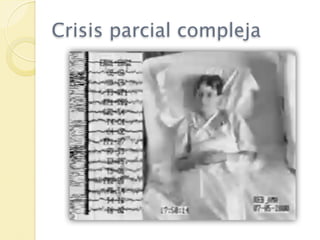 Crisis parcial compleja
 
