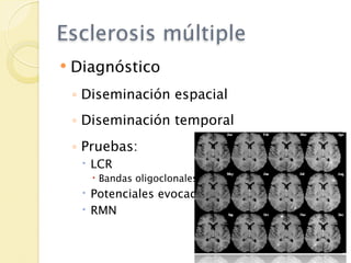 Esclerosis múltiple
   Diagnóstico
    ◦ Diseminación espacial
    ◦ Diseminación temporal
    ◦ Pruebas:
      LCR
        Bandas oligoclonales
      Potenciales evocados
      RMN
 