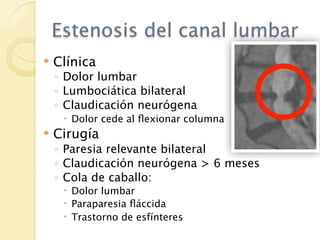 Estenosis del canal lumbar
   Clínica
    ◦ Dolor lumbar
    ◦ Lumbociática bilateral
    ◦ Claudicación neurógena
      Dolor cede al ﬂexionar columna
   Cirugía
    ◦ Paresia relevante bilateral
    ◦ Claudicación neurógena > 6 meses
    ◦ Cola de caballo:
      Dolor lumbar
      Paraparesia ﬂáccida
      Trastorno de esfínteres
 