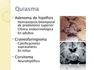 Quiasma
   Adenoma de hipóﬁsis
    ◦ Hemianopsia bitemporal
      de predominio superior
    ◦ Clínica endocrinológica
    ◦ En adultos
   Craneofaringioma
    ◦ Calciﬁcaciones
      supraselares
    ◦ En niños
   Corsitoma
    ◦ Neurohipóﬁsis
 