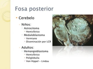 Fosa posterior
   Cerebelo
    ◦ Niños:
      Astrocitoma
        Hemisférico
      Meduloblastoma
        Vermiano
        Diseminación por LCR

    ◦ Adultos:
      Hemangioblastoma
        Hemisférico
        Poliglobulia
        Von Hippel - Lindau
 