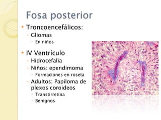 Fosa posterior
   Troncoencefálicos:
    ◦ Gliomas
      En niños

   IV Ventrículo
    ◦ Hidrocefalia
    ◦ Niños: ependimoma
      Formaciones en roseta
    ◦ Adultos: Papiloma de
      plexos coroideos
      Transtirretina
      Benignos
 