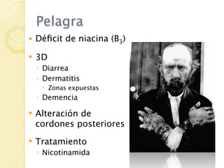 Pelagra
   Déﬁcit de niacina (B3)

   3D
    ◦ Diarrea
    ◦ Dermatitis
      Zonas expuestas
    ◦ Demencia

   Alteración de
    cordones posteriores
   Tratamiento
    ◦ Nicotinamida
 