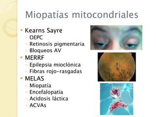 Miopatías mitocondriales
   Kearns Sayre
    ◦ OEPC
    ◦ Retinosis pigmentaria
    ◦ Bloqueos AV
   MERRF
    ◦ Epilepsia mioclónica
    ◦ Fibras rojo-rasgadas
   MELAS
    ◦   Miopatía
    ◦   Encefalopatía
    ◦   Acidosis láctica
    ◦   ACVAs
 
