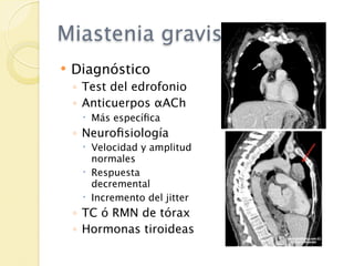 Miastenia gravis
   Diagnóstico
    ◦ Test del edrofonio
    ◦ Anticuerpos αACh
      Más especíﬁca
    ◦ Neuroﬁsiología
      Velocidad y amplitud
       normales
      Respuesta
       decremental
      Incremento del jitter
    ◦ TC ó RMN de tórax
    ◦ Hormonas tiroideas
 