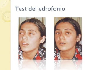 Test del edrofonio
 