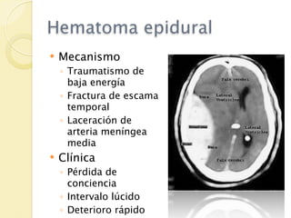 Hematoma epidural
   Mecanismo
    ◦ Traumatismo de
      baja energía
    ◦ Fractura de escama
      temporal
    ◦ Laceración de
      arteria meníngea
      media
   Clínica
    ◦ Pérdida de
      conciencia
    ◦ Intervalo lúcido
    ◦ Deterioro rápido
 