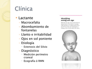 Clínica
   Lactante
    ◦ Macrocefalia
    ◦ Abombamiento de
      fontanelas
    ◦ Llanto e irritabilidad
    ◦ Ojos en sol poniente
    ◦ Etiología
      Estenosis del Silvio
    ◦ Diagnóstico
      Medición perímetro
       craneal
      Ecografía ó RMN
 