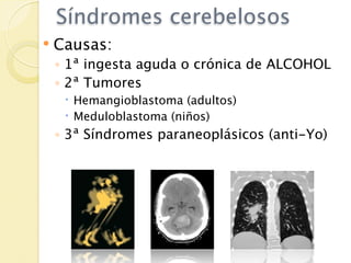 Síndromes cerebelosos
   Causas:
    ◦ 1ª ingesta aguda o crónica de ALCOHOL
    ◦ 2ª Tumores
      Hemangioblastoma (adultos)
      Meduloblastoma (niños)
    ◦ 3ª Síndromes paraneoplásicos (anti-Yo)
 