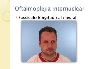 Oftalmoplejia internuclear
   Fascículo longitudinal medial
 