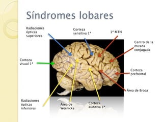 Síndromes lobares
    Radiaciones          Corteza
    ópticas              sensitiva 1ª            1ª MTN
    superiores
                                                              Centro de la
                                                              mirada
                                                              conjugada


Corteza
visual 1ª
                                                            Corteza
                                                            prefrontal




                                                          Área de Broca


Radiaciones
ópticas           Área de          Corteza
inferiores        Wernicke         auditiva 1ª
 