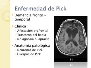 Enfermedad de Pick
   Demencia fronto –
    temporal
   Clínica
    ◦ Afectación prefrontal
    ◦ Trastorno del habla
    ◦ No agnosia ni apraxia

   Anatomía patológica
    ◦ Neuronas de Pick
    ◦ Cuerpos de Pick
 