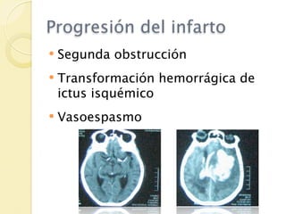 Progresión del infarto
   Segunda obstrucción
   Transformación hemorrágica de
    ictus isquémico
   Vasoespasmo
 