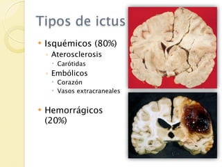 Tipos de ictus
   Isquémicos (80%)
    ◦ Aterosclerosis
      Carótidas
    ◦ Embólicos
      Corazón
      Vasos extracraneales


   Hemorrágicos
    (20%)
 