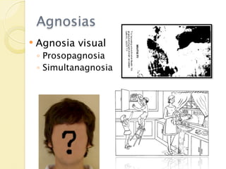 Agnosias
   Agnosia visual
    ◦ Prosopagnosia
    ◦ Simultanagnosia
 