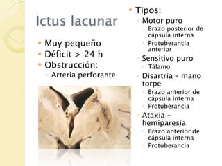    Tipos:
Ictus lacunar                  ◦ Motor puro
                                 Brazo posterior de
                                  cápsula interna
   Muy pequeño                  Protuberancia
                                  anterior
   Déﬁcit > 24 h              ◦ Sensitivo puro
   Obstrucción:                 Tálamo
    ◦ Arteria perforante       ◦ Disartria – mano
                                 torpe
                                 Brazo anterior de
                                  cápsula interna
                                 Protuberancia
                               ◦ Ataxia –
                                 hemiparesia
                                 Brazo anterior de
                                  cápsula interna
                                 Protuberancia
 