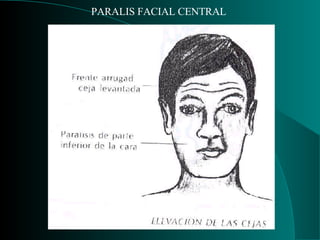PARALIS FACIAL CENTRAL  