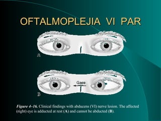 OFTALMOPLEJIA  VI  PAR Figure 4–16.  Clinical findings with abducens (VI) nerve lesion. The affected (right) eye is adducted at rest ( A ) and cannot be abducted ( B ). 