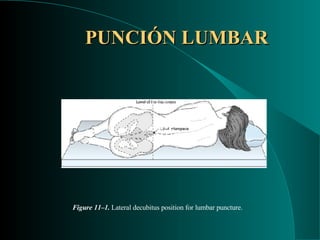 PUNCIÓN LUMBAR Figure 11–1.  Lateral decubitus position for lumbar puncture. 