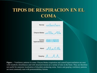 TIPOS DE RESPIRACION EN EL COMA Figure  .-  Ventilatory patterns in coma. Cheyne-Stokes respiration and central hyperventilation are seen with metabolic disturbances and with structural lesions at a variety of sites in the brain. They are therefore not useful for anatomic localization of disorders producing coma. Ataxic and gasping ventilatory patterns are most commonly seen with pontomedullary lesions. 