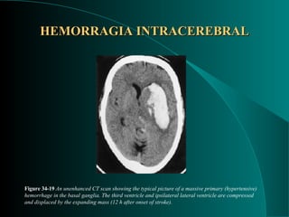 HEMORRAGIA INTRACEREBRAL Figure 34-19   An unenhanced CT scan showing the typical picture of a massive primary (hypertensive) hemorrhage in the basal ganglia. The third ventricle and ipsilateral lateral ventricle are compressed and displaced by the expanding mass (12 h after onset of stroke). 
