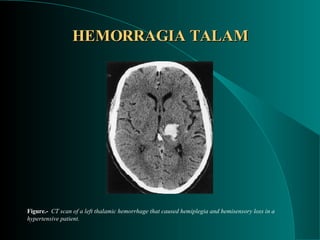 HEMORRAGIA TALAM Figure .-  CT scan of a left thalamic hemorrhage that caused hemiplegia and hemisensory loss in a hypertensive patient. 