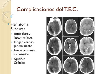 Complicaciones del T.E.C. Hematoma Subdural: entre dura y leptomeninge. Origen venoso generalmente. Puede asociarse a contusión Agudo y Crónico. FDLF 