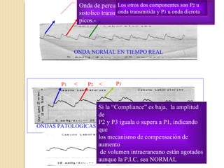 P 1  > P 2  > P 3 Onda de percusión, representa el latido arterial sistolico transmitido, siendo el más alto de los tres picos.- Los otros dos componentes son P 2  u onda transmitida y P 3  u onda dicrota ONDA NORMAL EN TIEMPO REAL P 1  < P 2  < P 3 ONDA EN Tº REAL En tienda de campaña ONDAS PATOLOGICAS Si la “Compliance” es baja,  la amplitud de  P2 y P3 iguala o supera a P1, indicando que  los mecanismo de compensación de aumento de volumen intracraneano están agotados  aunque la P.I.C. sea NORMAL 