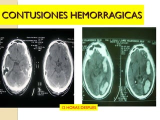 CONTUSIONES HEMORRAGICAS 12 HORAS DESPUES 
