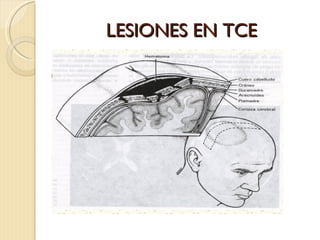 LESIONES EN TCE 