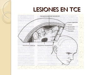 LESIONES EN TCE 