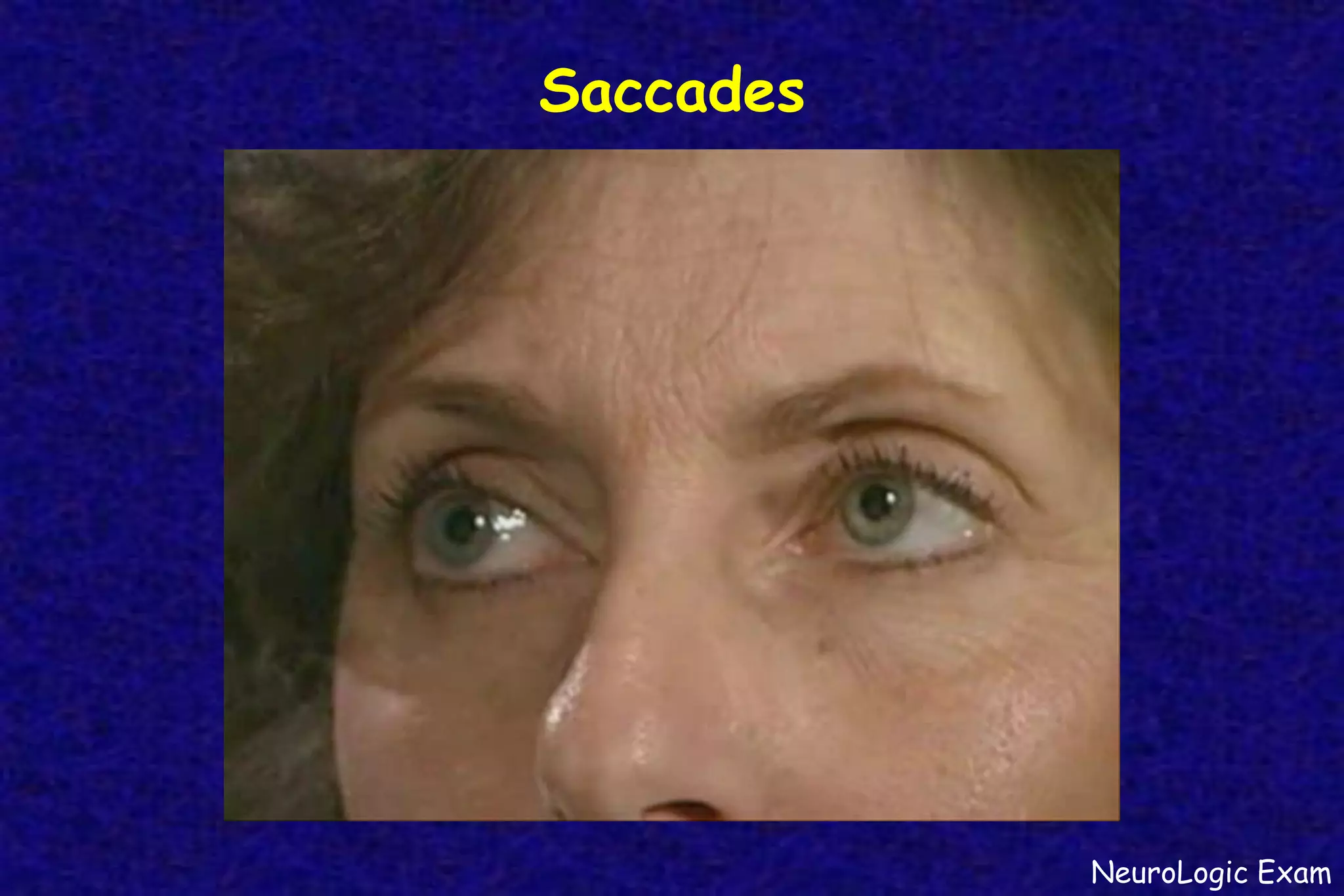 Saccades
NeuroLogic Exam
 