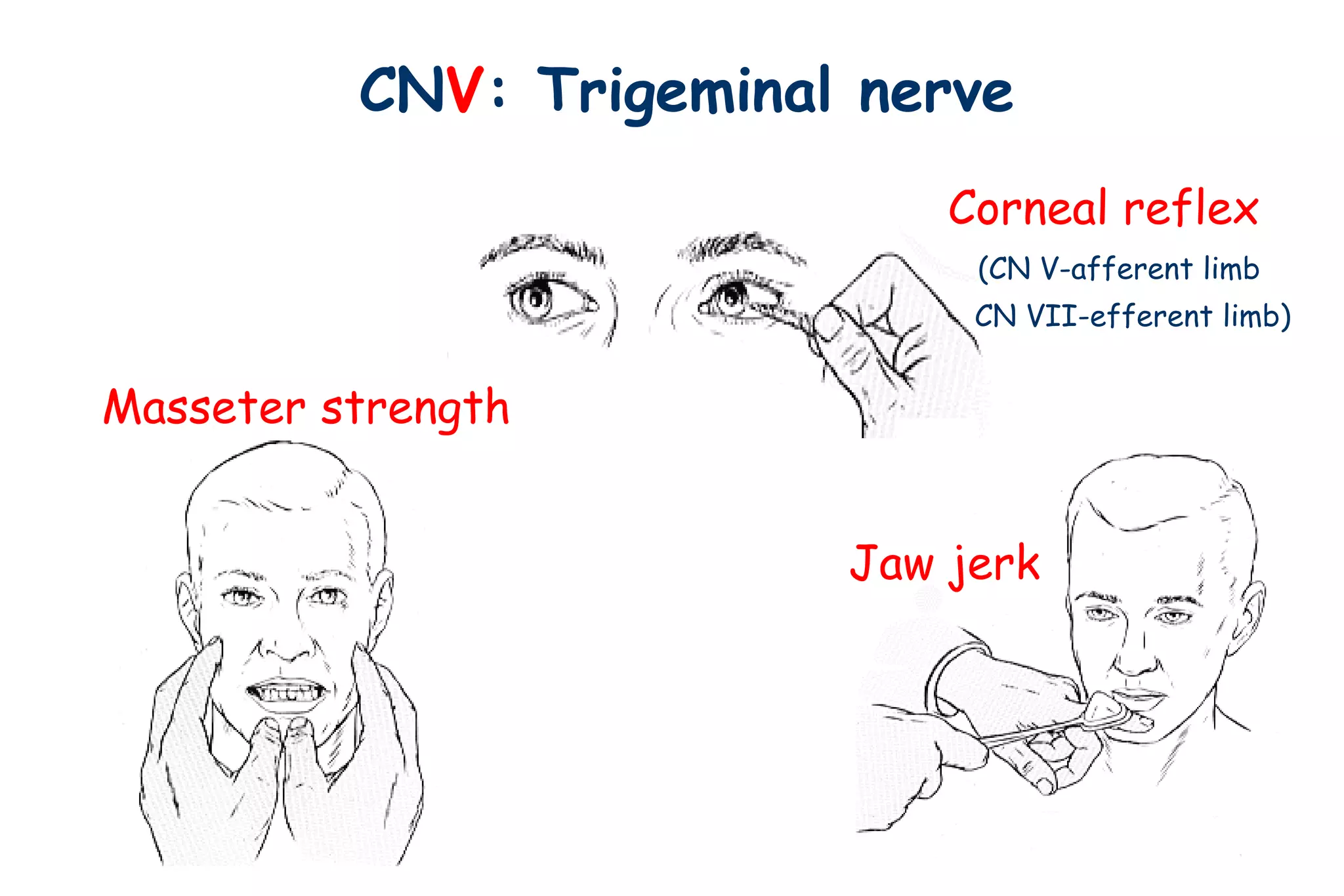 CNV: Trigeminal nerve
Corneal reflex
(CN V-afferent limb
CN VII-efferent limb)
Jaw jerk
Masseter strength
 
