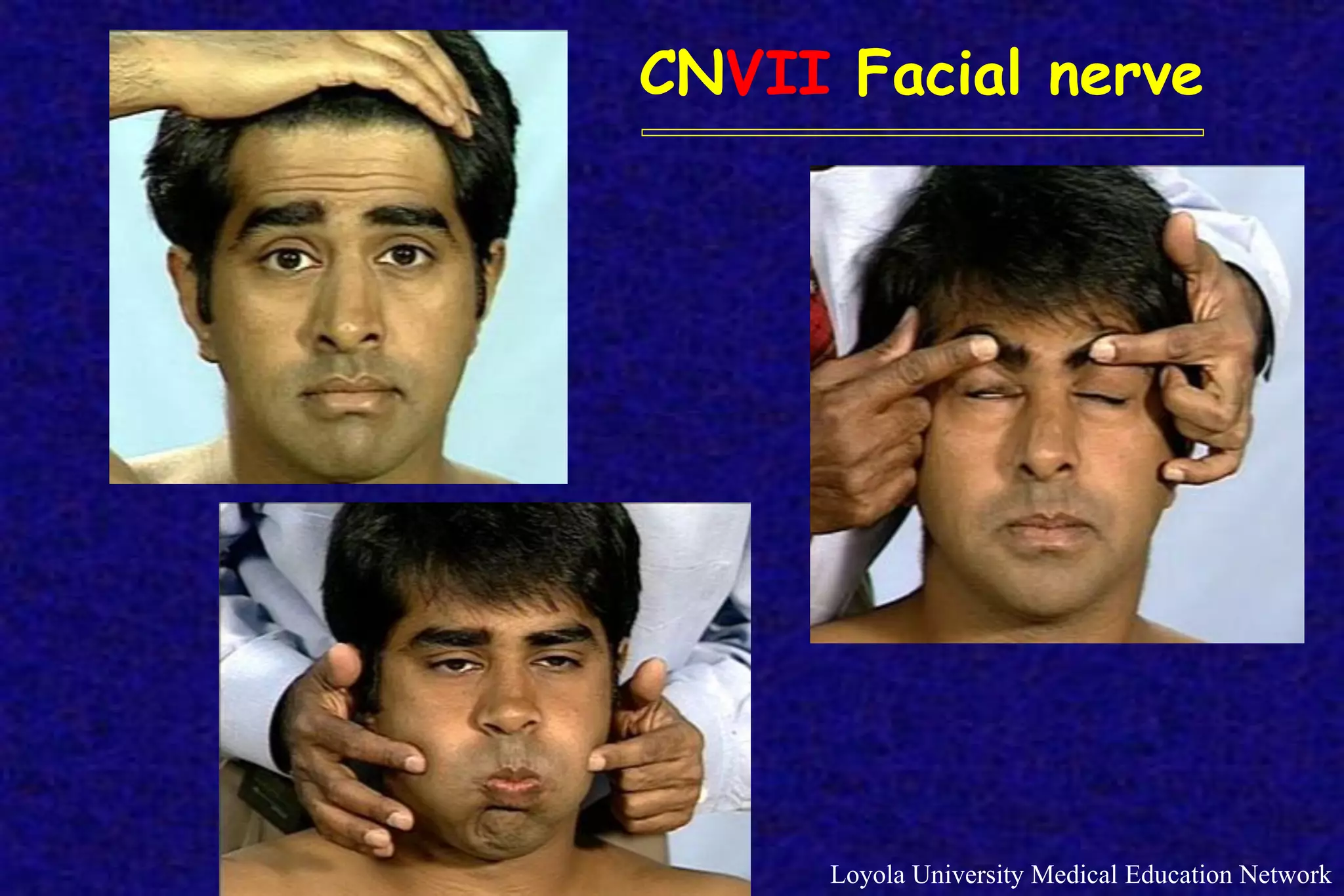 Loyola University Medical Education Network
CNVII Facial nerve
 