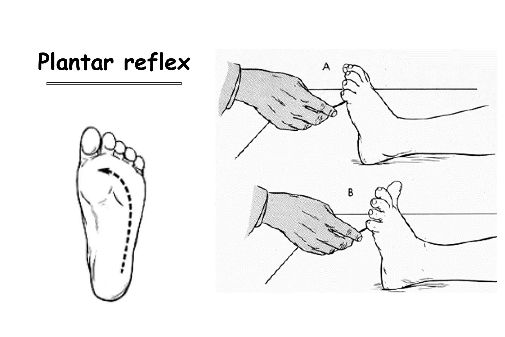 Plantar reflex
 