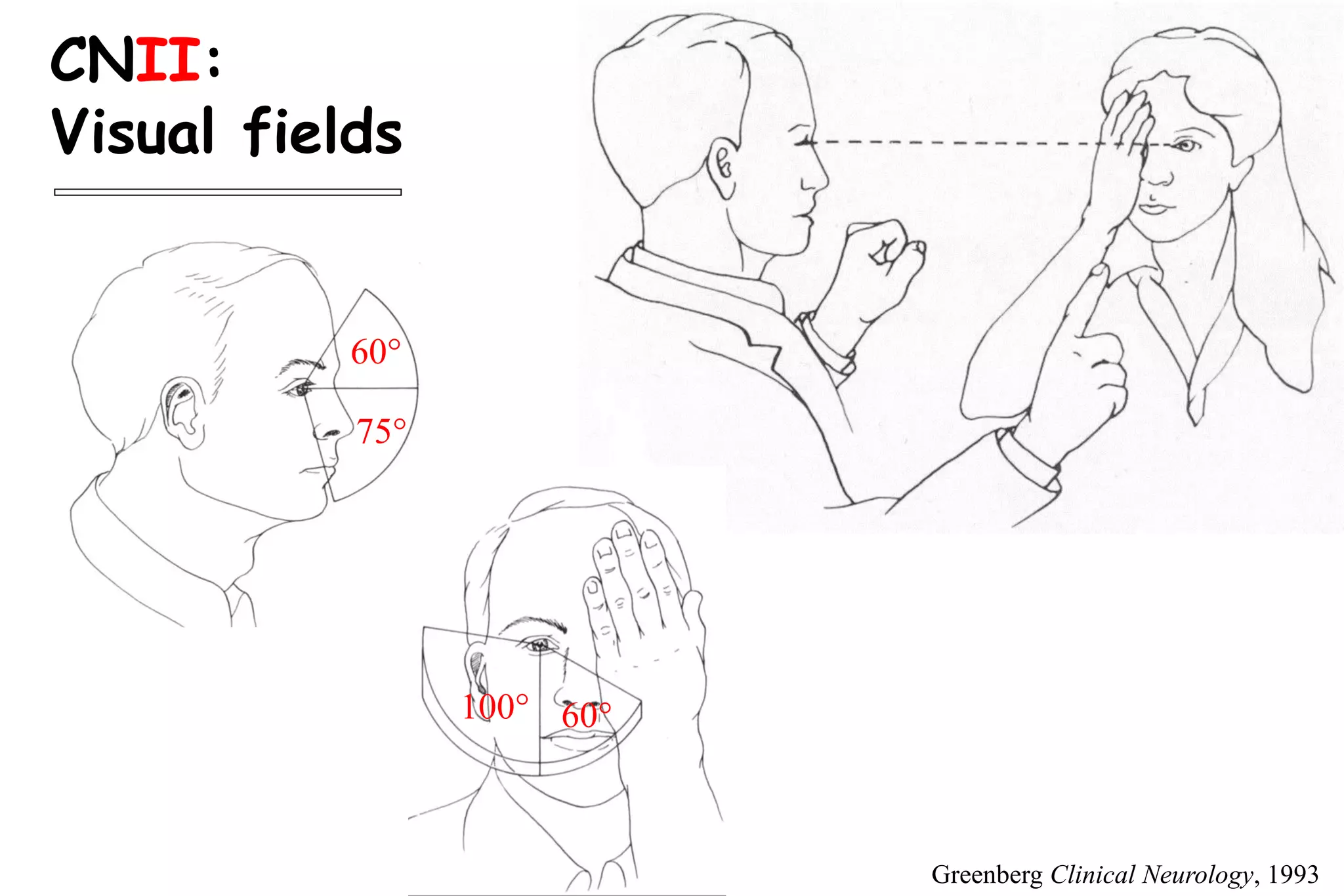 CNII:
Visual fields
60
75
100 60
Greenberg Clinical Neurology, 1993
 