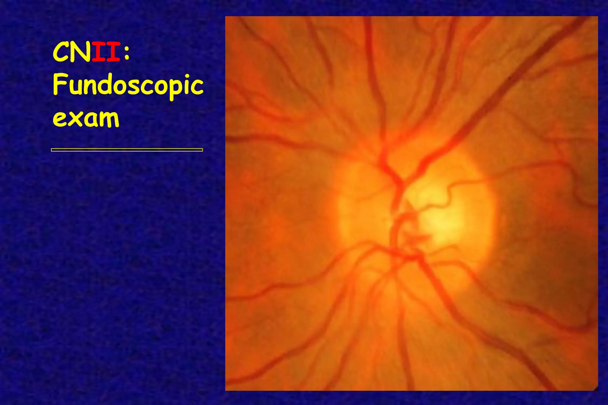CNII:
Fundoscopic
exam
 