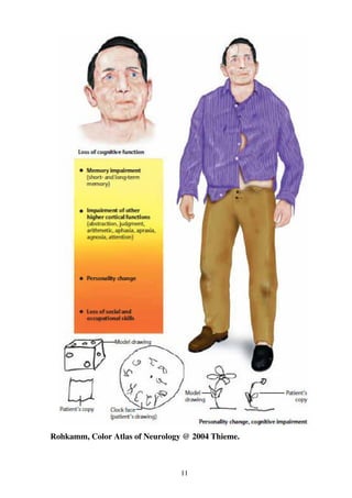 11
Rohkamm, Color Atlas of Neurology @ 2004 Thieme.
 