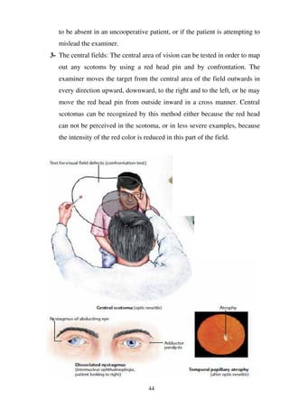 44
to be absent in an uncooperative patient, or if the patient is attempting to
mislead the examiner.
3- The central fields: The central area of vision can be tested in order to map
out any scotoms by using a red head pin and by confrontation. The
examiner moves the target from the central area of the field outwards in
every direction upward, downward, to the right and to the left, or he may
move the red head pin from outside inward in a cross manner. Central
scotomas can be recognized by this method either because the red head
can not be perceived in the scotoma, or in less severe examples, because
the intensity of the red color is reduced in this part of the field.
 