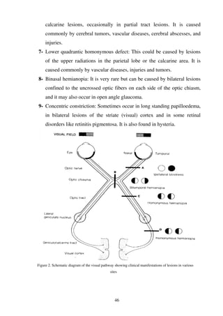 46
calcarine lesions, occasionally in partial tract lesions. It is caused
commonly by cerebral tumors, vascular diseases, cerebral abscesses, and
injuries.
7- Lower quadrantic homonymous defect: This could be caused by lesions
of the upper radiations in the parietal lobe or the calcarine area. It is
caused commonly by vascular diseases, injuries and tumors.
8- Binasal hemianopia: It is very rare but can be caused by bilateral lesions
confined to the uncrossed optic fibers on each side of the optic chiasm,
and it may also occur in open angle glaucoma.
9- Concentric constriction: Sometimes occur in long standing papilloedema,
in bilateral lesions of the striate (visual) cortex and in some retinal
disorders like retinitis pigmentosa. It is also found in hysteria.
Figure 2. Schematic diagram of the visual pathway showing clinical manifestations of lesions in various
sites
 